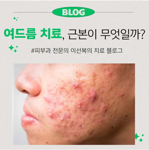 여드름의 근본적인 치료 가능할까?