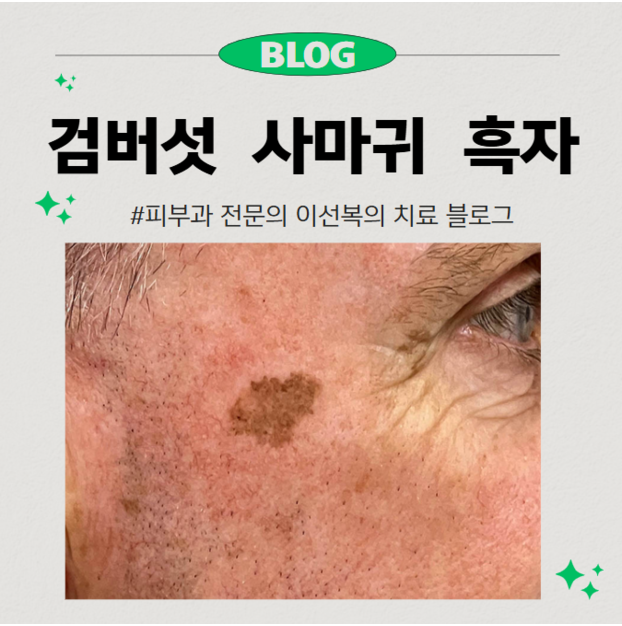 사마귀vs검버섯vs흑자, 그 구분은 어떻게 하나요?