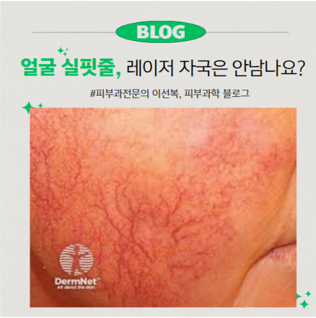 실핏줄 레이저는 언제 어떻게 할까