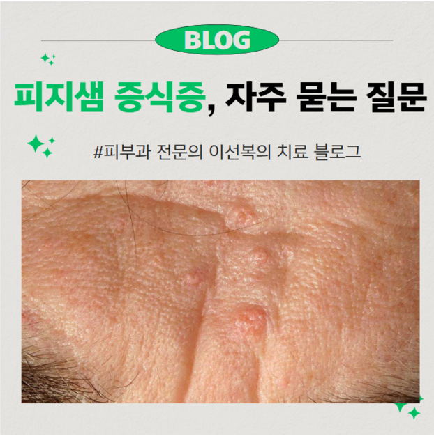 피지샘 증식증 치료, 자주 묻는 질문들