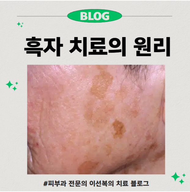 흑자 치료의 원리/효과/부작용/경과