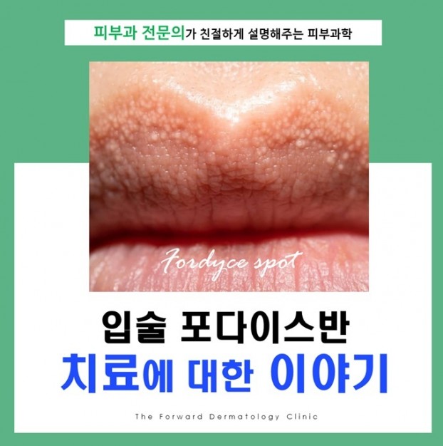 포다이스반 치료는 어떻게 하나요?